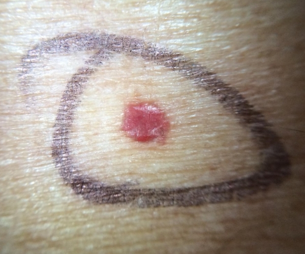 Example of cherry angioma showing small round red growth on skin